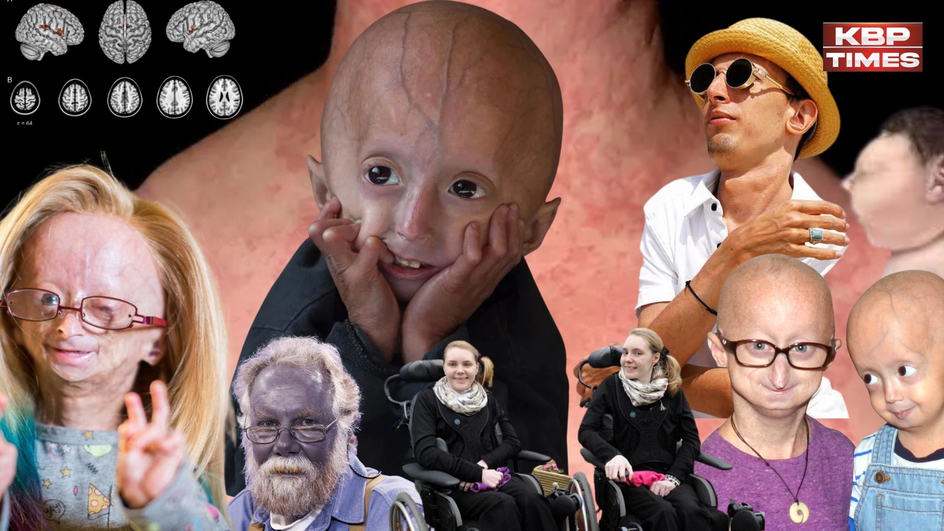 दुनिया की सबसे अजीब और दुर्लभ बीमारियां: मरीजों की हालत सुनकर रह जाएंगे दंग