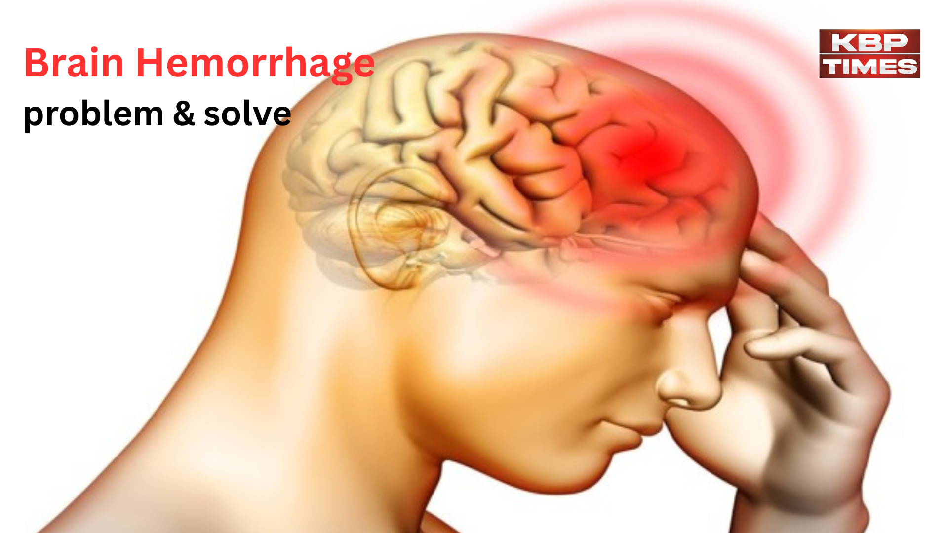 Brain hemarrage