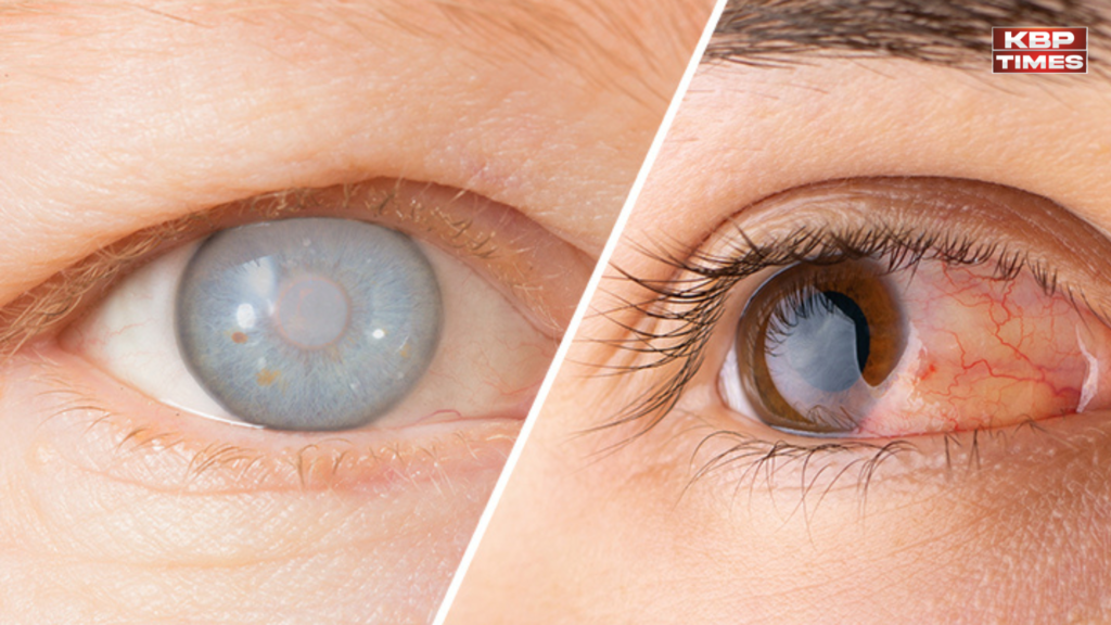 Cataract Prevention Tips धुंधली न हो आंखों की रोशनी