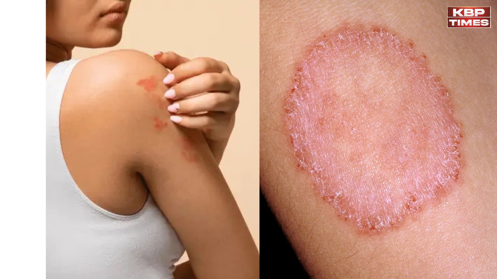 ringworm treatment